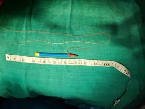 Prisoner private part Pencil Surgery