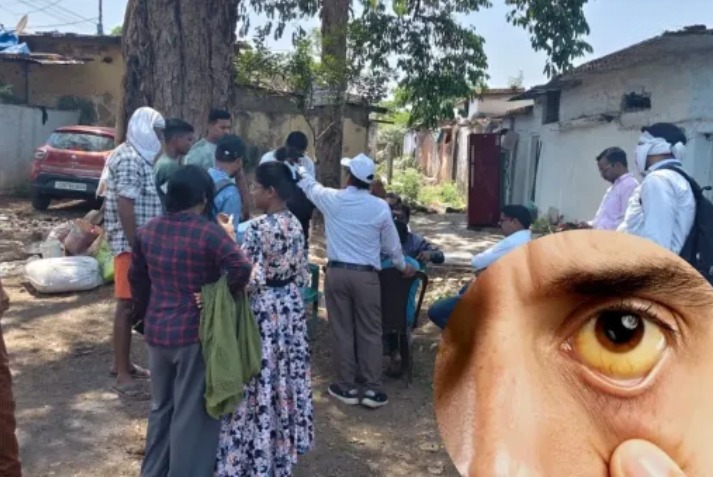 Bhilai Jaundice Case: