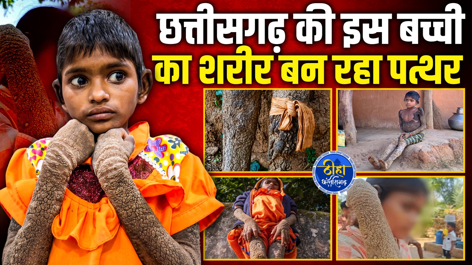 CG News: छत्तीसगढ़ की इस बच्ची का शरीर बन रहा पत्थर, एम्स में भर्ती
