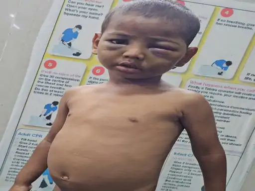 Raipur News: राजधानी रायपुर के तरुण नगर इलाके में तीन मासूम बच्चों के साथ मारपीट और प्रताड़ना का मामला सामने आया है। आरोप है कि सगी मां और सौतेले पिता बच्चों को छोटी-छोटी बातों पर बेरहमी से पीटते थे और कई बार खाना भी नहीं देते थे। सबसे छोटे 3 वर्षीय रोहित के शरीर पर 20 से अधिक चोट के निशान मिले हैं। उसकी पिटाई से हाथ फ्रैक्चर हो गया, सिगरेट से दागे, जबकि चेहरे और आंख के आसपास भी गंभीर चोटें आई हैं। मामले में पुलिस ने मां अन्नू देवी पासवान को गिरफ्तार कर लिया है, जबकि आरोपी सौतेला पिता राजा दीप फरार है।